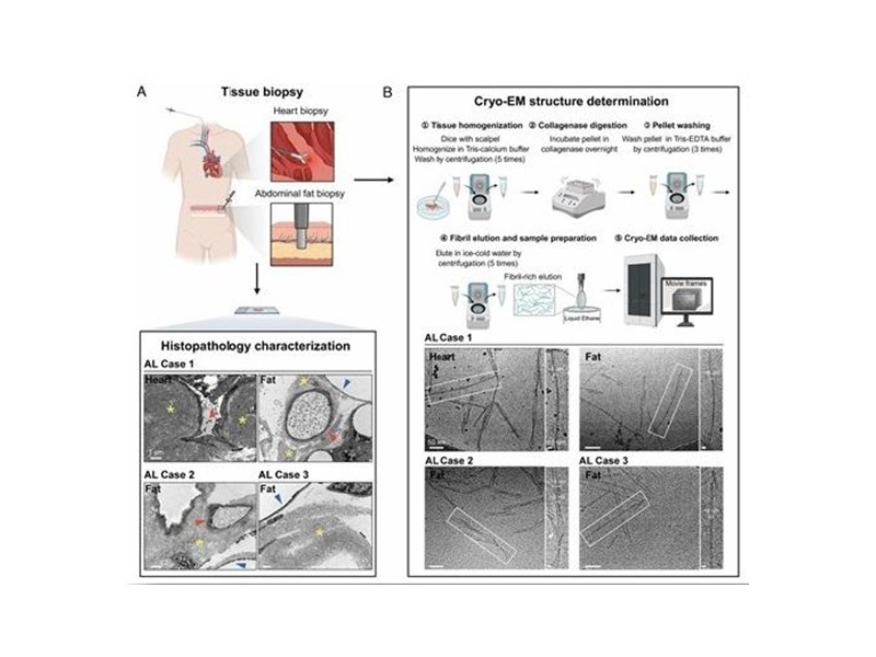 上海交大Bio-X研究院李丹团队与合作者开发基于病理聚集体的轻链淀粉样变性病活检诊断新方法